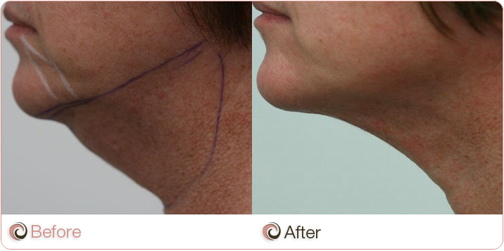 110311-COSCLI-before_and_after-liposuction-neck-62