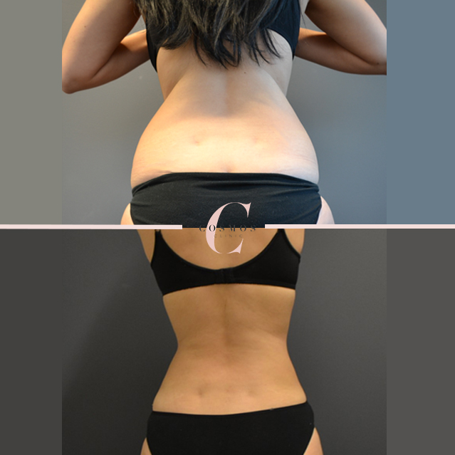 Liposuction, Coolsculpting, & BodyTite